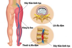 Đau thần kinh tọa, có thể gây liệt chân