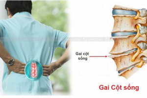 GAI CỘT SỐNG CÓ ĐIỀU TRỊ DỨT ĐIỂM ĐƯỢC KHÔNG?