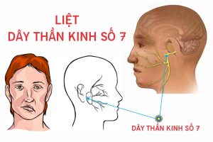 Liệt dây thần kinh số 7 ngoại biên có nguy hiểm không