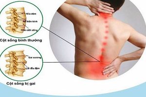 CÁCH ĐIỀU TRỊ ĐAU LƯNG GAI CỘT SỐNG