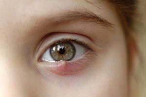 Điều trị bệnh lẹo mắt hiệu quả tại Tâm An 