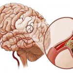 Điều trị di chứng sau tai biến mạch máu não