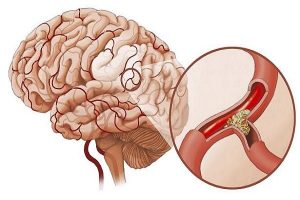 Điều trị di chứng sau tai biến mạch máu não