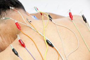 Phương pháp điều trị viêm quanh khớp vai bằng điện châm