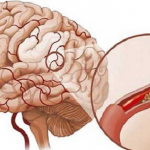 Cách điều trị sau tai biến mạch máu não hiệu quả