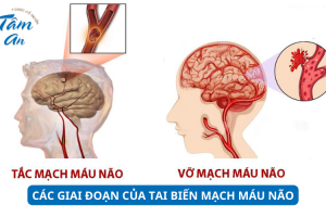 Các giai đoạn của tai biến mạch máu não
