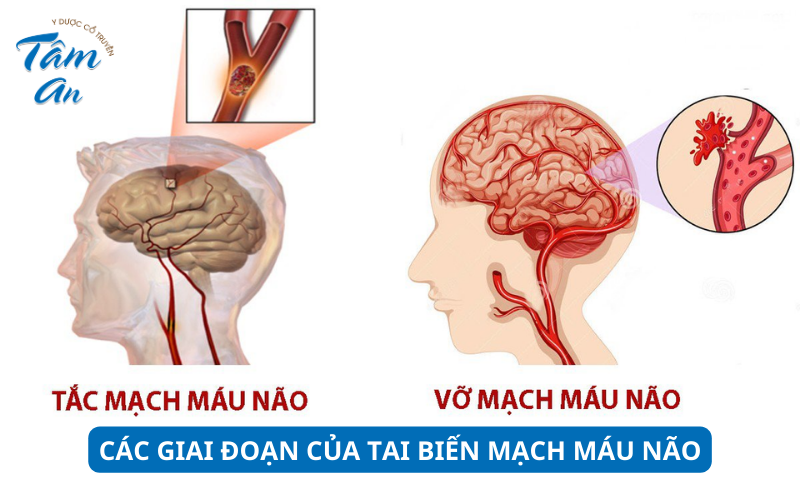 Các giai đoạn của tai biến mạch máu não - Hình 1