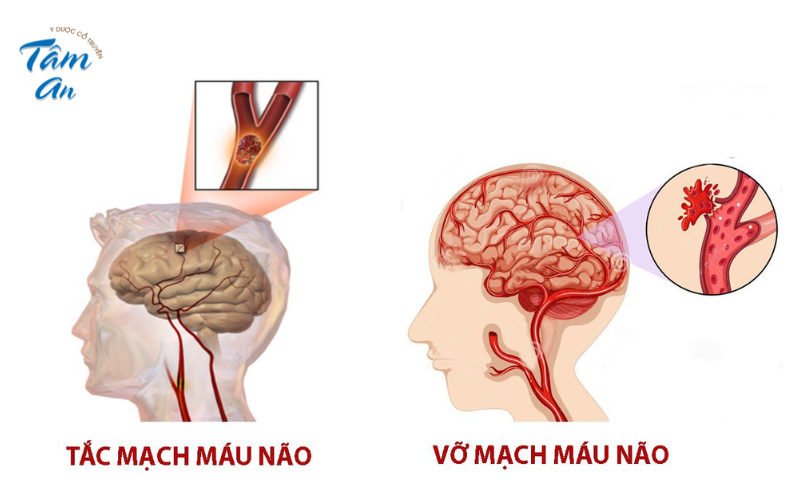 Nguyên tắc phục hồi chức năng sau tai biến mạch máu não - Hình 2