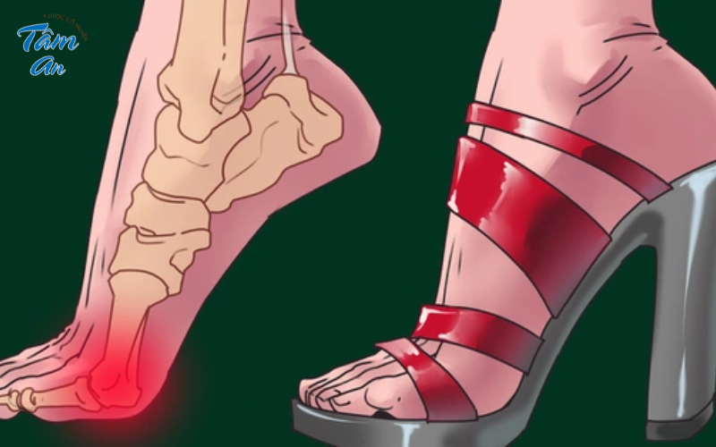 Mẹo đi giày cao gót không ảnh hưởng đến xương khớp - Hình 1