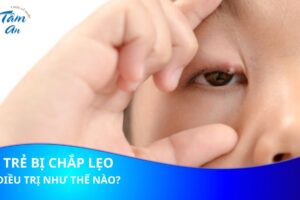 Bé nổi mụn ở mi mắt có phải là bị chắp mắt?