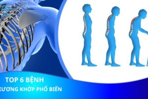 Top 6 căn bệnh xương khớp phổ biến ở người Việt Nam