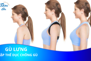 Gù lưng là gì? Tập thể dục có chống gù lưng không?