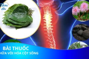 3 Bài thuốc dân gian chữa vôi hóa cột sống lưng cực hay