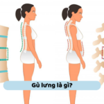 Gù lưng là gì? Nguyên nhân, triệu chứng và cách phòng ngừa