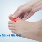 Bệnh Gút và Giả Gút: khác biệt đến mức nào?