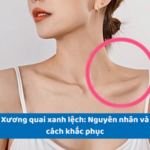 Xương quai xanh lệch: Nguyên nhân và cách khắc phục