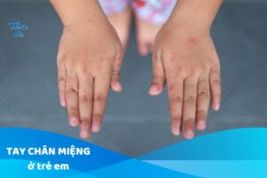 Tay Chân Miệng Ở Trẻ: Dấu Hiệu, Cách Chăm Sóc & Phòng Ngừa
